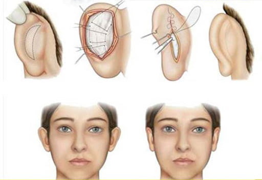 جراحی زیبایی گوش - دکتر نجمی