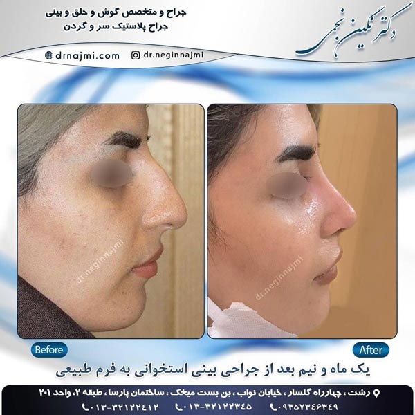 جراحی زیبایی بینی