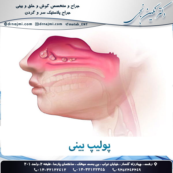 پولیپ بینی - دکتر نجمی