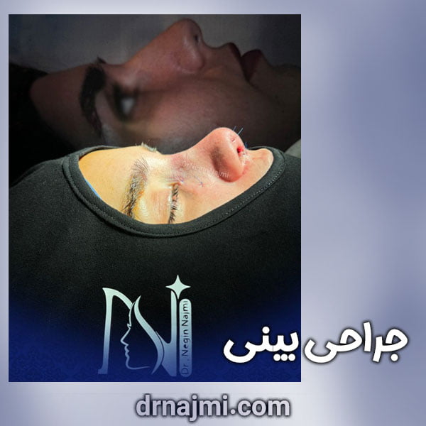 جراحی بینی در رشت توسط دکتر نگین نجمی