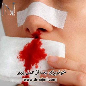 خونریزی بعد از عمل بینی