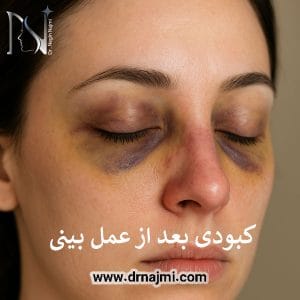 کبودی بعد از عمل بینی