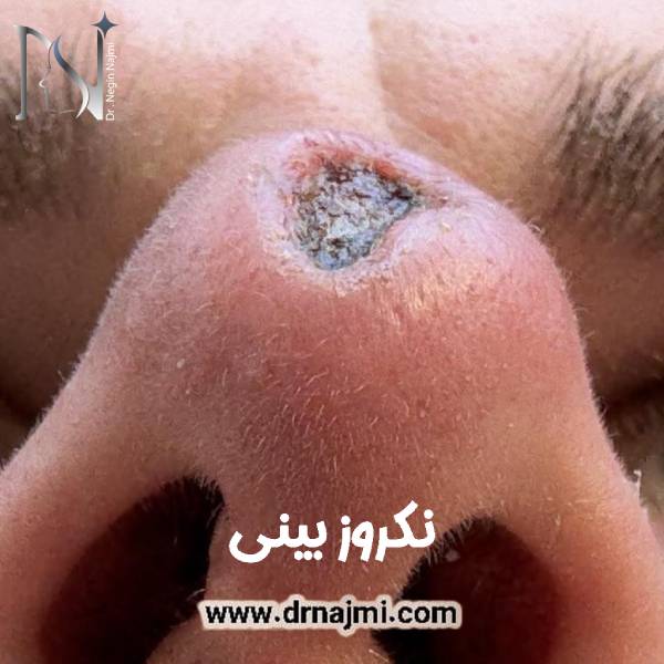 نکروز بینی
