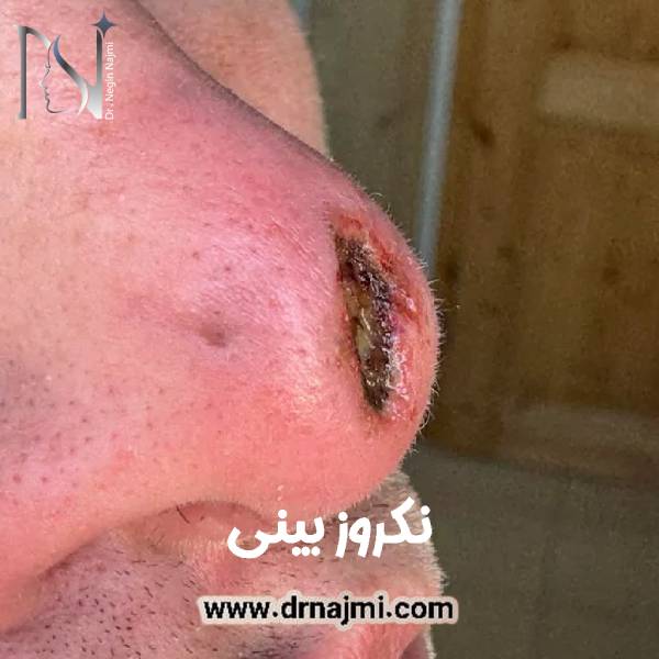 نکروز بینی
