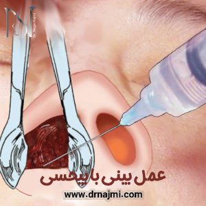 عمل بینی با بیحسی