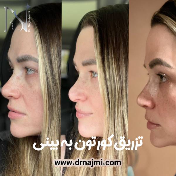 تزریق کورتون به بینی