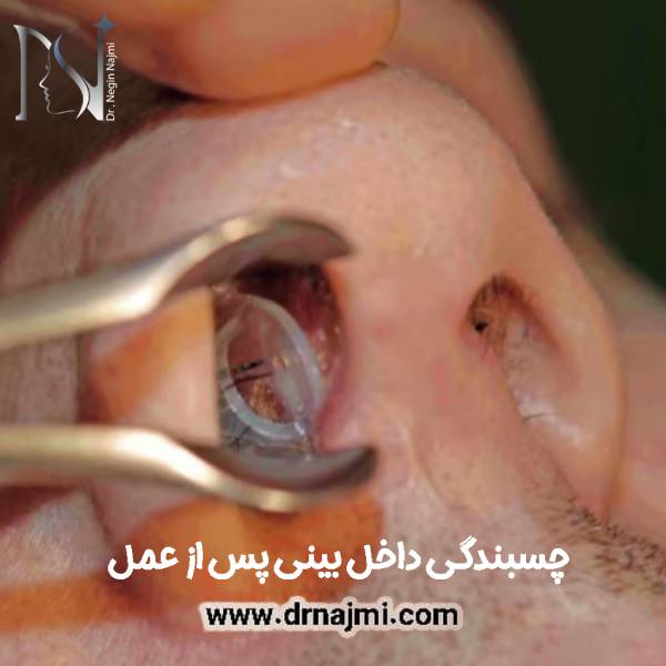 چسبندگی بینی بعد از جراحی