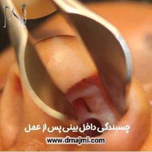 چسبندگی بینی بعد از عمل