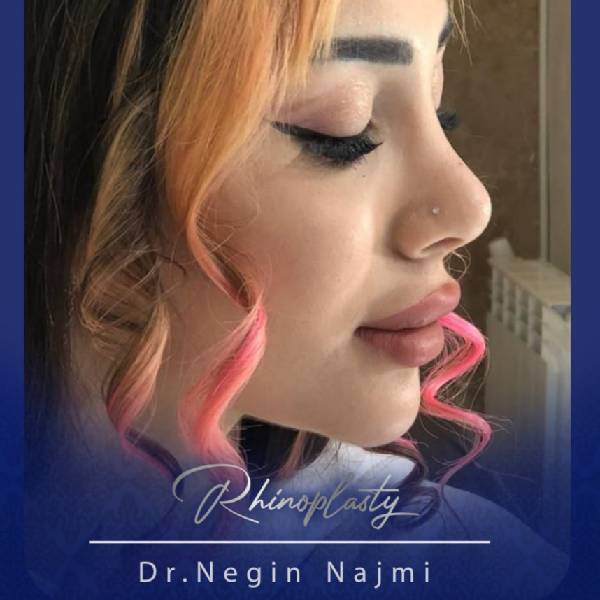 جراحی زیبایی بینی