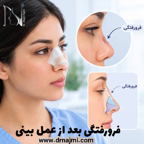فرورفتگی بعد از عمل بینی