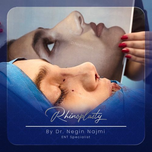 جراحی-بینی-127