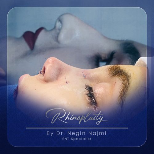 جراحی-بینی-128