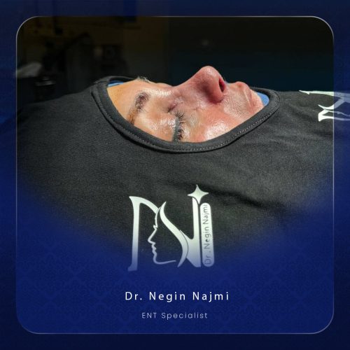 جراحی-بینی-133