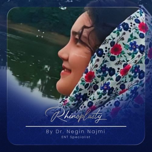 جراحی-بینی-135