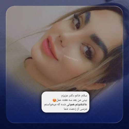 جراحی-بینی-151