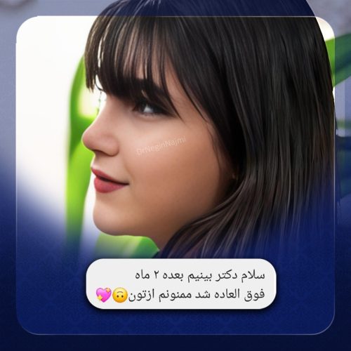 جراحی-بینی-152