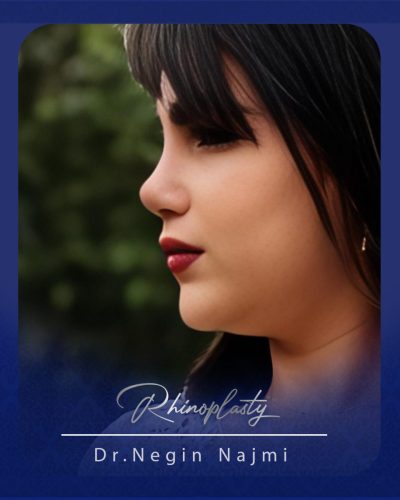 جراحی-بینی-160