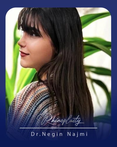 جراحی-بینی-165