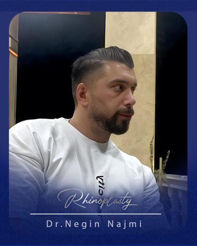جراحی-بینی-172